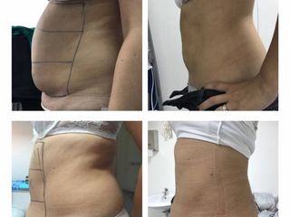 lipoaspiracion abdomen