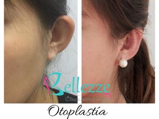 Otoplastía