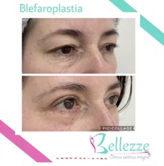 Blefaroplastia superior e inferior 