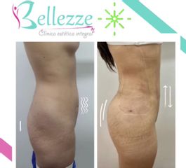 Lipoaspiración vaser y transferencia glúteo 
