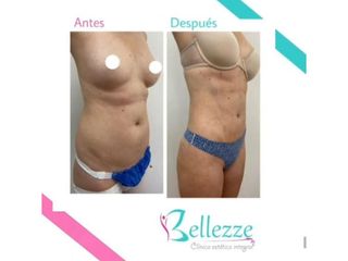Clinica Bellezze - Liposucción