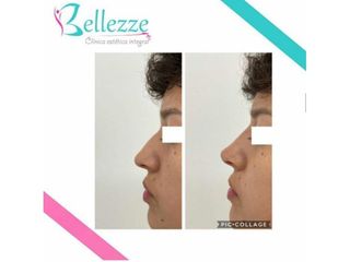 Clinica Bellezze - Rinomodelación