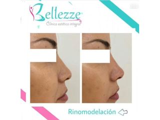 Clinica Bellezze - Rinomodelación