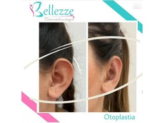 Clinica Bellezze - Otoplastia