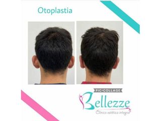 Clinica Bellezze - Otoplastia