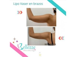 Clinica Bellezze - Lipossución vaser en brazos