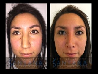 Rinoplastia - 560620
