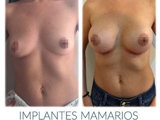 Aumento mamario