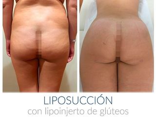 Liposuccion con lipoinjerto de gluteos