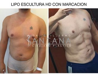 Fotos de Lipoescultura - Cómo se desarrolla la Cirugía