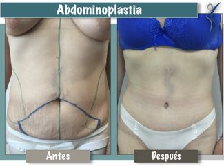 Abdominoplastia