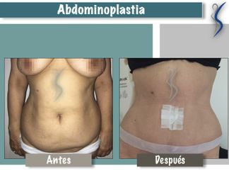 Abdominoplastia