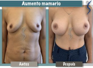 Aumento mamario