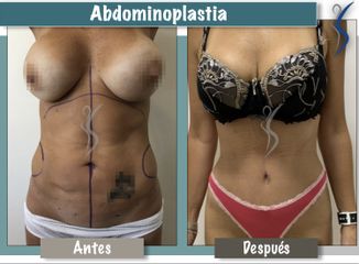 Abdominoplastia