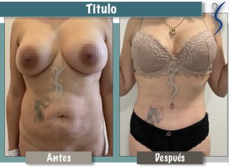 Abdominoplastia