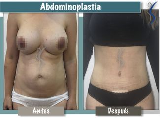 Abdominoplastia