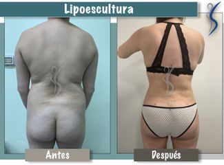 Lipoescultura