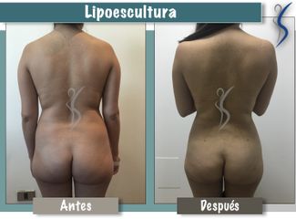 Lipoescultura