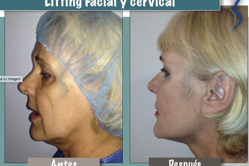 Lifting antes y después - 660896