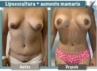 Aumento mamario y Lipoescultura