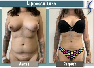Lipoescultura