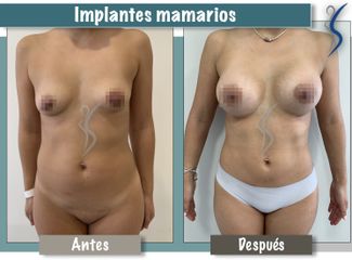 Implantes mamarios
