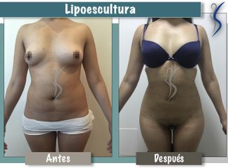 Lipoescultura