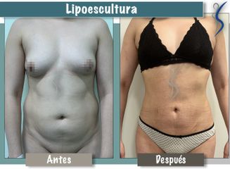 Lipoescultura
