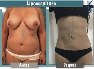 Lipoescultura