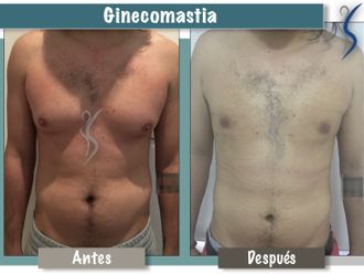 Ginecomastia - 660908