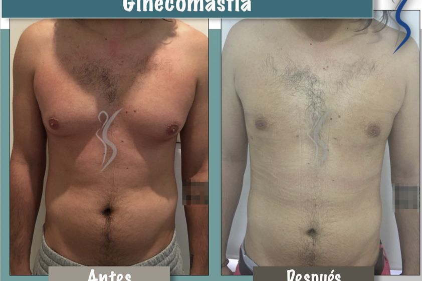 Ginecomastia antes y después - 660908
