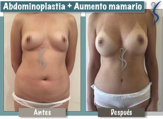 Aumento mamario y Abdominoplastia