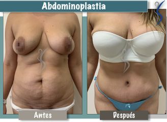 Abdominoplastia 