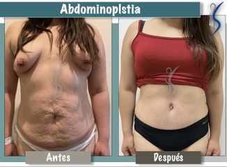 Abdominoplastia 