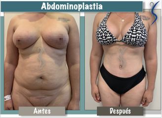 Abdominoplastia 