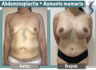 Aumento mamario y Abdominoplastia