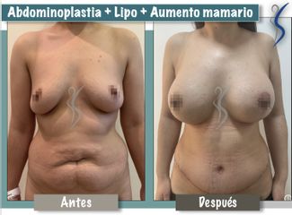 Abdominoplastia y aumento mamario