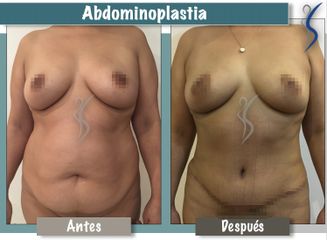 Abdominoplastia