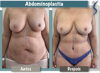 Abdominoplastia