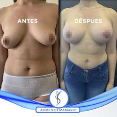 Aumento Mamario  -Dr. Guillermo Santana