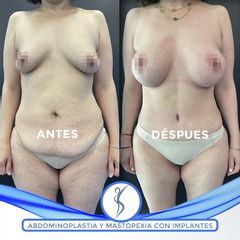 Abdominoplastia y Mastopexia con Implantes - Dr. Guillermo Santana