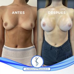 Aumento Mamario - Dr. Guillermo Santana