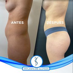Implante de Gluteos - Dr. Guillermo Santana