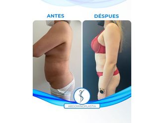 Abdominoplastía antes y después - 851862