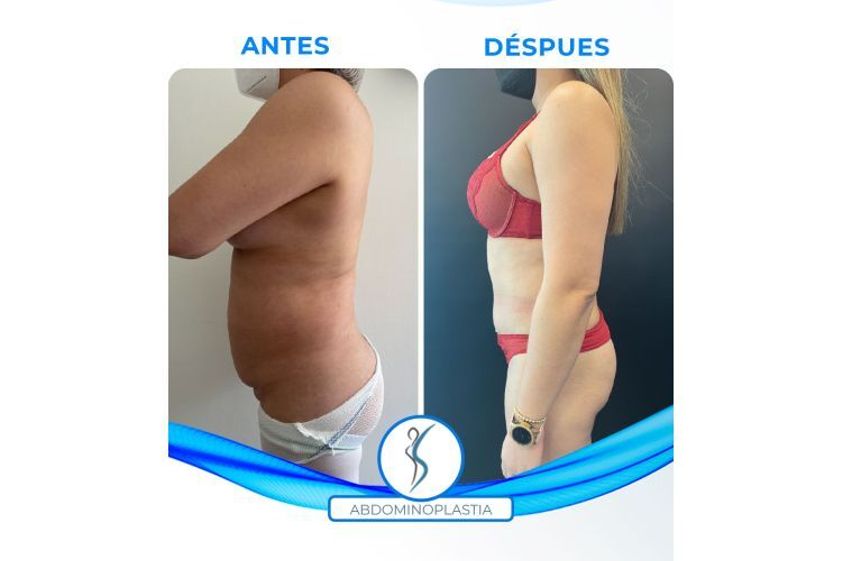 Abdominoplastía antes y después - 851862