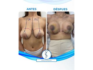 Mastopexia - Dr. Santana
