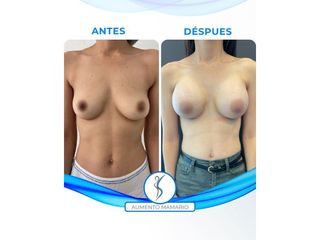Aumento Mamario - Dr. Santana