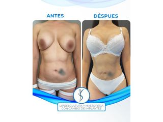Lipoescultura + Mastopexia con Implantes - Dr. Santana