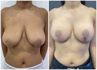 Mastopexia - Dr. Guillermo Santana