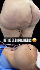 Retiro de Biopolimeros - Dr. Guillermo Santana